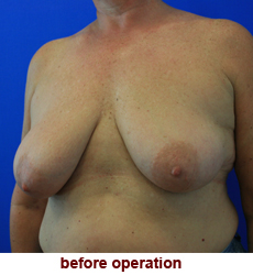 plastic-surgery-breast-lift-augmentation